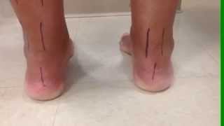 Patient D Clinician Ann Maximum Pronation Test [upl. by Neelram248]