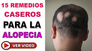 Como Tratar La Alopecia Areata Con La Ayuda De Estos 15 Remedios Caseros [upl. by Detta337]