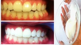 HOW I WHITEN MY BROWN TEETH AT HOME IN 5 MINUTES 100 WORKING [upl. by Rebah]