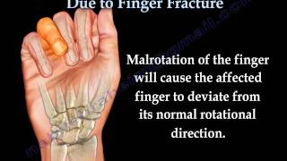 Finger Fractures Malrotation Of The Fingers  Everything You Need To Know  Dr Nabil Ebraheim [upl. by Marcille]