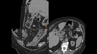 Cholecystoenteric fistula and gallstone small bowel obstruction [upl. by Annavoj131]