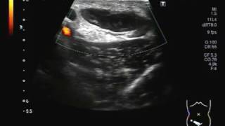 Ultrasound Video showing an Inguinal abscess [upl. by Casady]