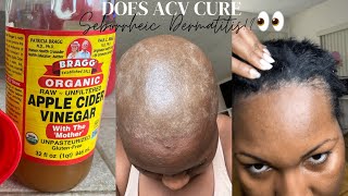 Treating My Seborrheic Dermatitis with ACV RINSE Remedy 🙆🏾😫👀😅 [upl. by Oilegor32]