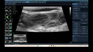 IQ 315 PYOMETRA ULTRASOUND ECHOPAC ANALYSIS UTERUS [upl. by Evelinn]