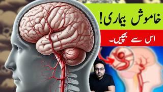 Dr ZeeAneurysm A Silent Killer  डॉक्टर ज़ी [upl. by Saitam853]