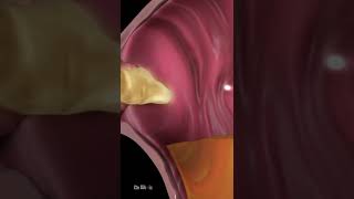 What Is Acid Reflux Animation [upl. by Legyn]