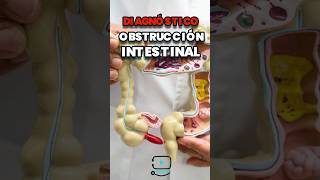 ¿intestino irritable u obstrucción intestinal  doctor jovel cirujano [upl. by Malvino448]