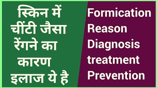 त्वचा में चींटी जैसे चलने का आभाष होता हैFormication Under Skin Treatmentत्वचा में चींटी चलती है [upl. by Nytsuj837]