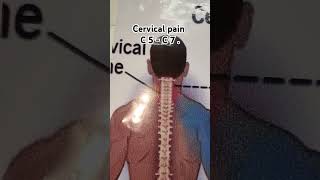 Cervical Spondylitis C5 C7 tread by Girva basti Chiropractic [upl. by Gerti]