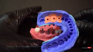 Impression Techniques for Implant Dentistry   step by step  Closed tray Impression technique [upl. by Bael]