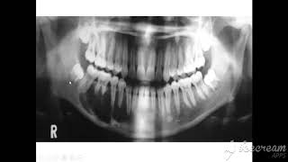 radiographic features of ameloblastoma [upl. by Adley]