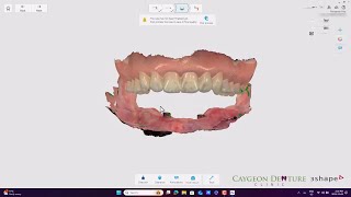 Complete Lower Denture over Implants IOS [upl. by Aubarta]