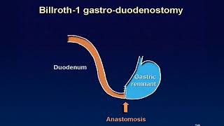 01 Billroth 1 reconstruction animation [upl. by Kanter]