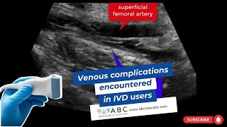 Venous complications encountered in IVD users deep vein thrombosis seroma fistula pseudoaneurysm [upl. by Byler324]