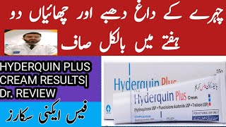 Hyderquin plus cream uses Melasma Hyperpigmentation freckle and acne scar treatment formula cream [upl. by Nosaj]