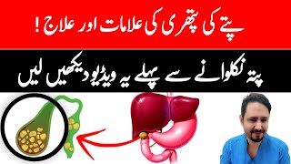 Gallbladder Stones  Bile Salt In Urdu Hindi  Dr Irfan [upl. by Egiedan]