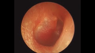 Glomus tympanicum middle ear paraganglioma [upl. by Roosnam899]