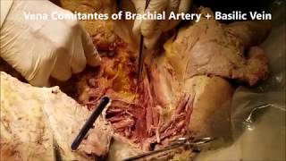 AXILLA Dissection BRACHIAL PLEXUS AXILLARY VESSELS Nodes Clinical Aspects – Sanjoy Sanyal [upl. by Newob]