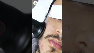 Acne Scar Removal Procedure for Flawless Skin at Care Well Medical Centre [upl. by Ian850]