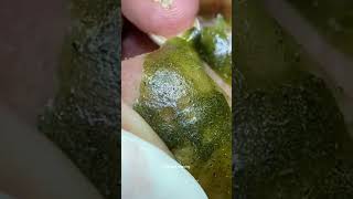 Blackheads Removal  Acne Treatment and Very Satisfying Satisfying Pimple pop blackheads [upl. by Inalaehon]