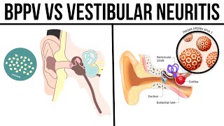 BPPV vs Vestibular Neuritis [upl. by Albin]