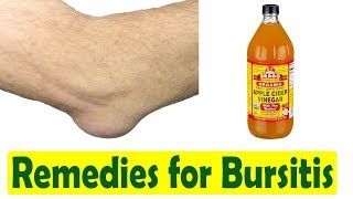 How to Cure Bursitis  Home Remedies for Bursitis [upl. by Kreit]