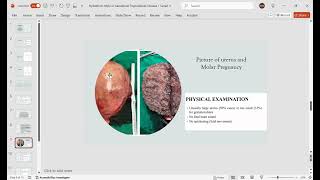 Hydatiform mole or Gestational Trophoblastic Disease [upl. by Macintosh]