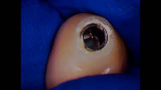 Dental Implant Saved From Disaster 4 [upl. by Lynnworth522]