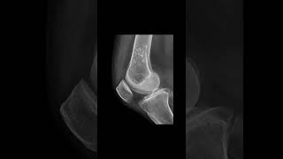 Enchondroma of distal femur xrayknee [upl. by Sirraj]