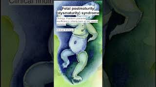 Fetal postmaturity dysmaturity syndrome [upl. by Trent191]