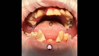 Severe Periodontal Disease with bone loss generalized inflammation and tissue edema [upl. by Tteragram]