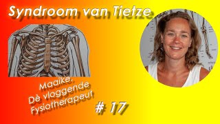 17 Fysiotherapie bij het Syndroom van Tietze maak een afspraak en kom van jouw klachten af [upl. by Eimrej]