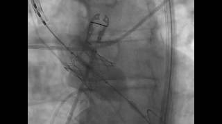 TAVR Implantation Aortogram under Fluoroscopic Guidance SAPIEN 3 [upl. by Ninon]