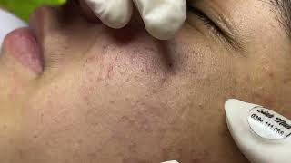 Acne treatment for Spa Linh Mun 2023 026 [upl. by Ashby167]