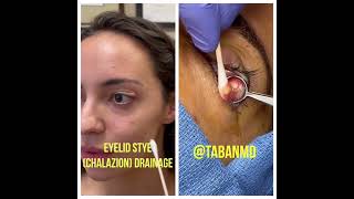 Scarless chalazion drainage [upl. by Atirahs]