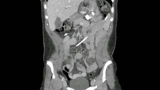 Radiology Rounds  radRoundscom CT Scan of Gastric Lap Band [upl. by Sharia]