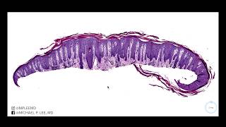 Psoriasis versus nummular dermatitis Dermpath made easy [upl. by Tica]