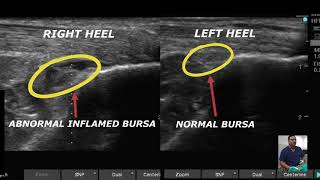 RETRO CALCANEAL BURSITIS PRP PLATELET RICH PLASMA THERAPY REGENERATIVE THERAPY [upl. by Zumwalt]