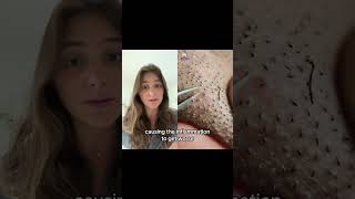 What happens when you extract your ingrown hairs with a tweezer ingrownhair ingrownhairremoval [upl. by Mcclain]