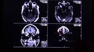 thyroid opthalmopathy in T2 and STIR mri sequence by Radiologie TV [upl. by Nnylrats]