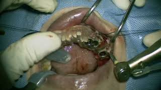 Straumann NC RN WN place in posterior mandible 2 [upl. by Oleta31]