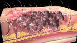 Burns Classification and Treatment [upl. by Rednave]