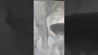 Varicocele Embolization  Varicocele treatment without surgery  Varicocele varicoceletreatment [upl. by Eedak]