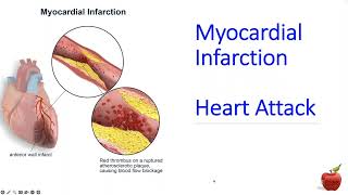 ICD 10 CM coding for a Heart Attack STEMI vs NSTEMI for Beginners [upl. by Ozneral]