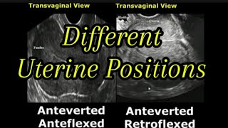 Uterine Positions In Ultrasound  AntevertedRetroverted  AnteflexedRetroflexed Uterus [upl. by Maggio161]