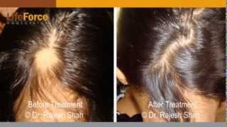 Alopecia Areata treatment and cure using homeopathy at Life Force [upl. by Richarda]