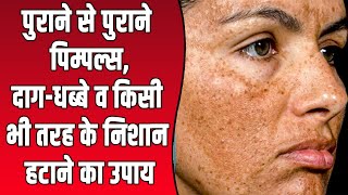 पुराने से पुराने दाग किसी भी तरह के काले निशान हटाने का उपाय blogout pimple pimpleremover [upl. by Ahseikan]