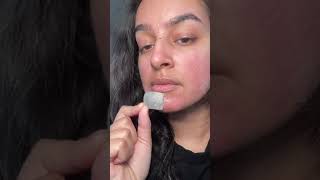 Satisfying Acne Patch Removal acneproneskin acnecommunity pimplepopper [upl. by Llerrad]