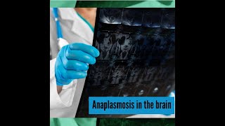 Anaplasmosis causes neurologic problems [upl. by Camilla]