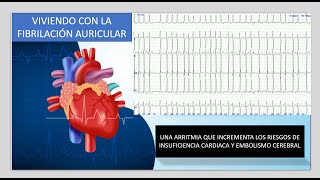 Fibrilación Auricular [upl. by Euqinwahs]